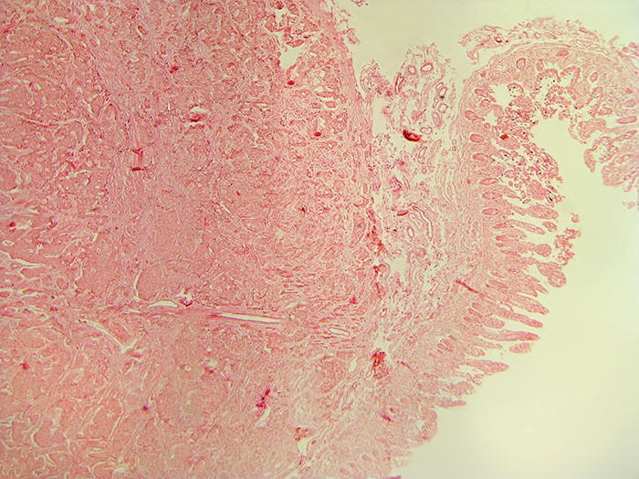 carcinoid tumor